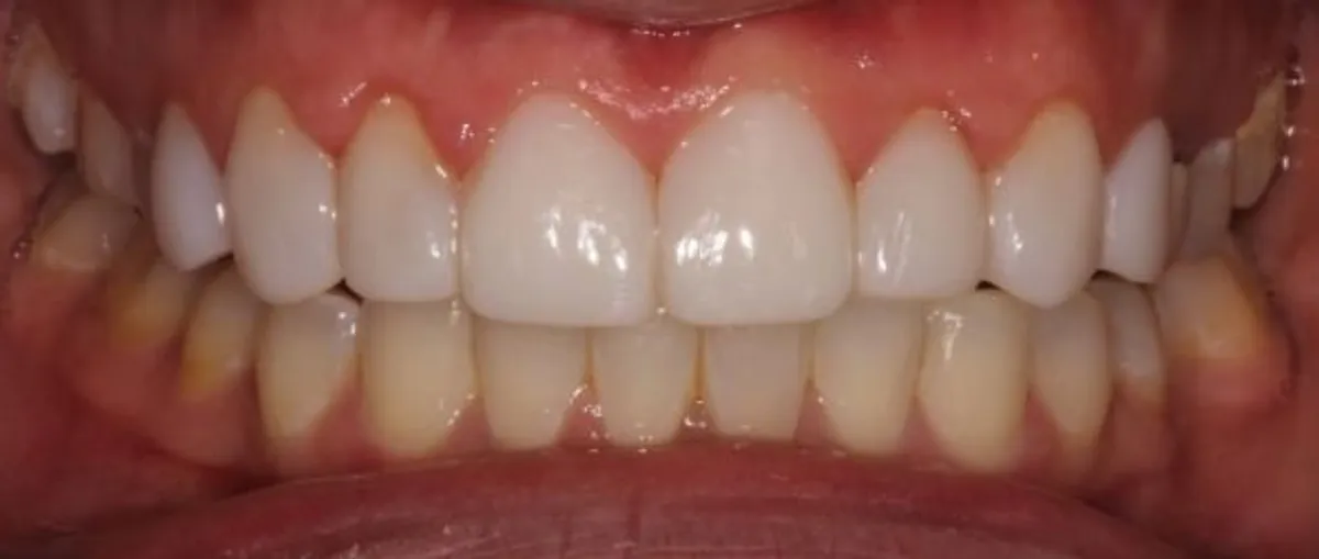 After: Front teeth reshaped and evened after Bioclear
