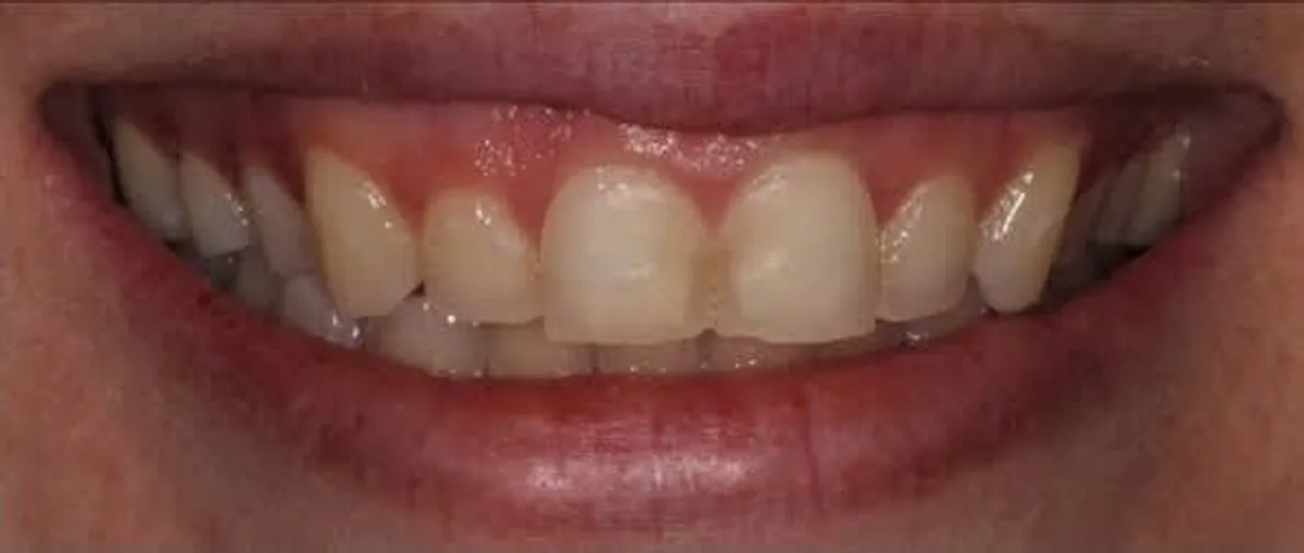 Before: Uneven, discolored front teeth before Bioclear
