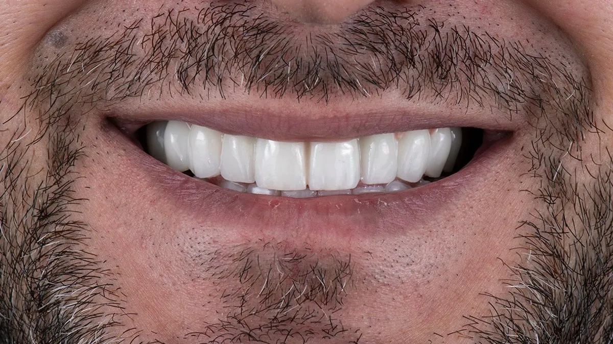 After: The same smile with a full row of restored teeth