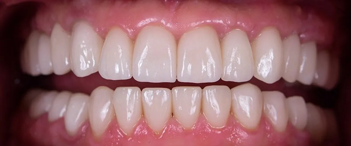 After: A complete set of even, white upper and lower teeth