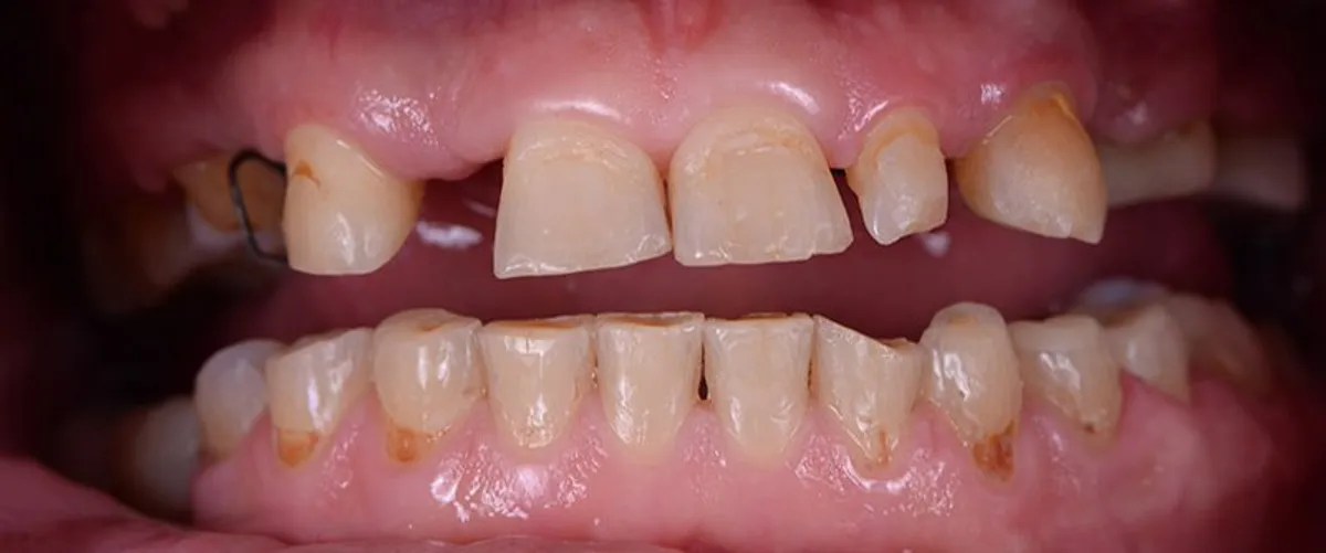 Before: Broken, worn and missing upper front teeth