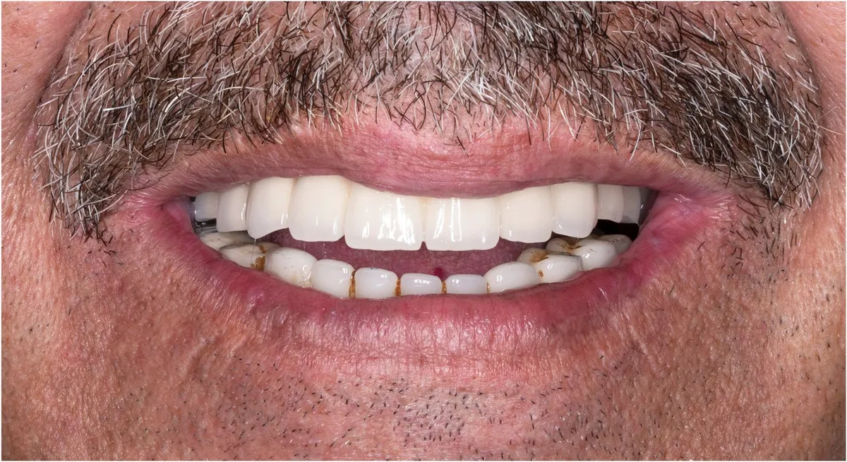 After: The same mouth with a full upper arch of implant-supported teeth