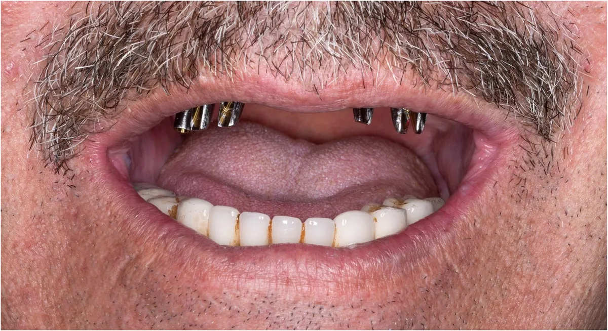 Before: Upper arch with implant posts and no teeth