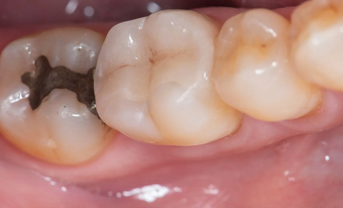 After: A molar restored with a tooth-colored inlay