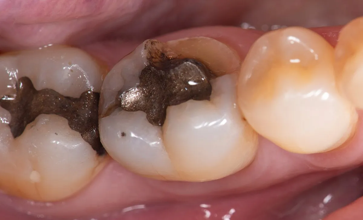 Before: Molars with dark metal fillings