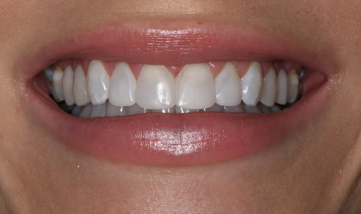 After: Smile after the makeover with brighter, even teeth